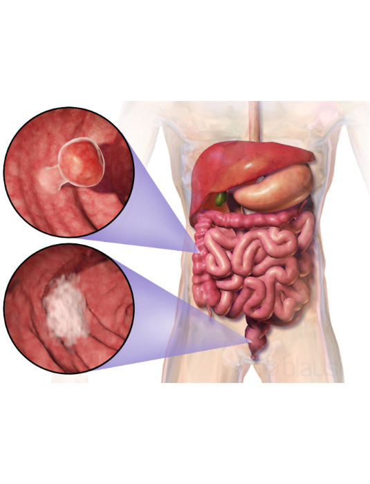 Colorectal Cancer