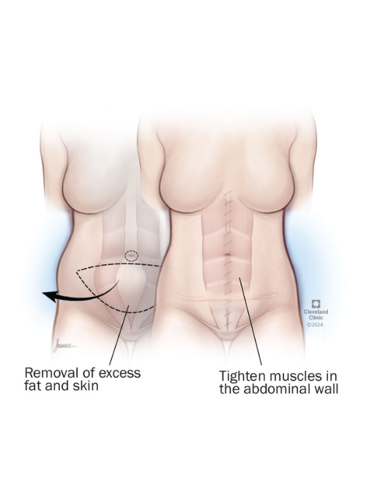 Abdominoplasty