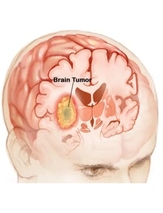 Brain Tumor Surgery