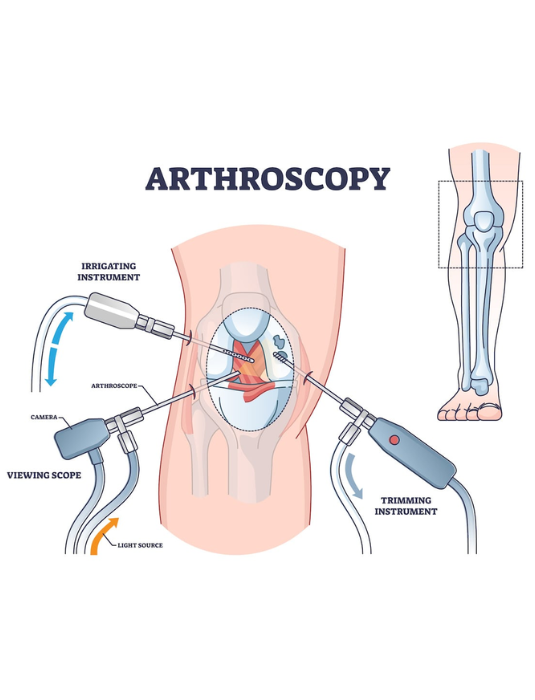 Knee Arthroscopy