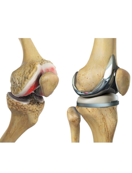 Knee Replacement