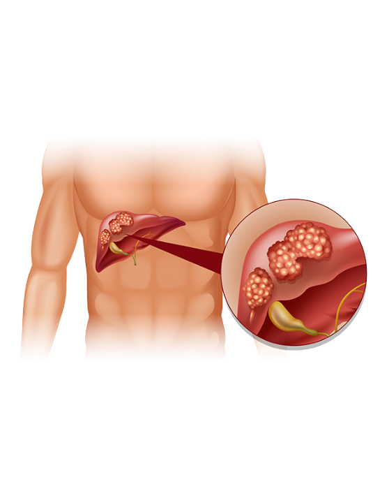 Liver Cancer Surgery