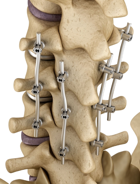 Spinal Fusion