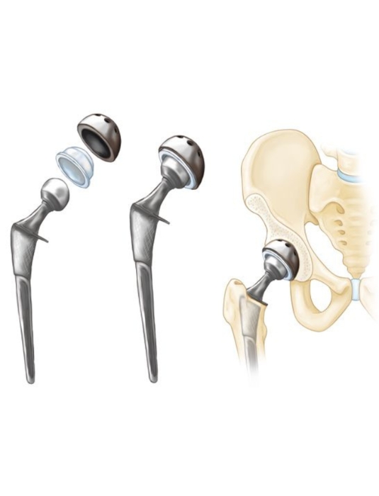 Hip Replacement