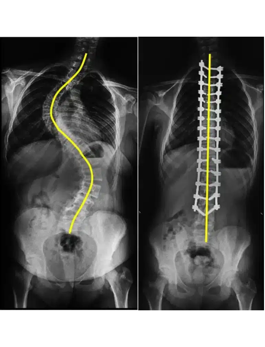 Scoliosis Surgery