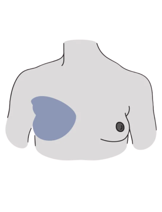 Mastectomy