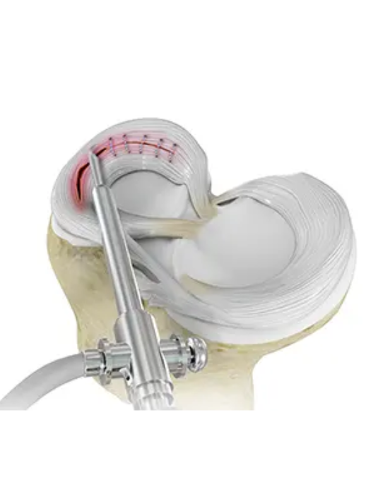 Meniscus Repair